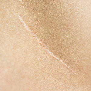 Scar