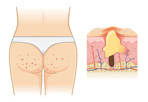 Butt Acne, is this for Real?